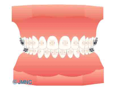 ブラケット矯正(ホワイト)