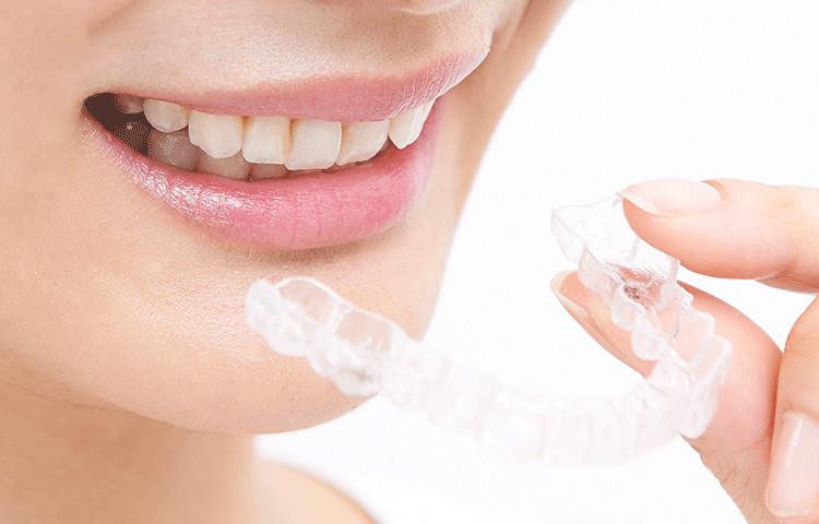 マウスピース矯正